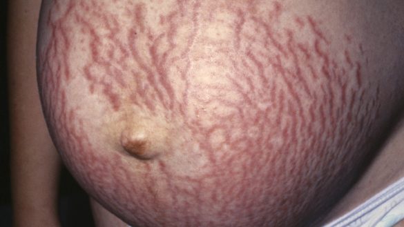 Raskausarvet eli venytysjuovat